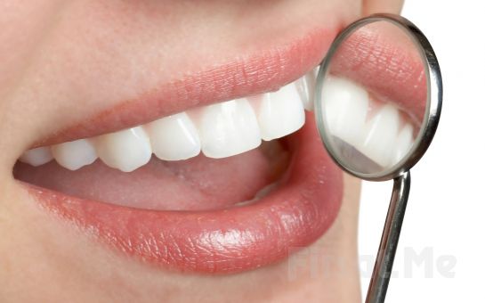 Bahçelievler Dentalove Ağız ve Diş Sağlığı’ndan Lazer ile Diş Beyazlatma İşlemi
